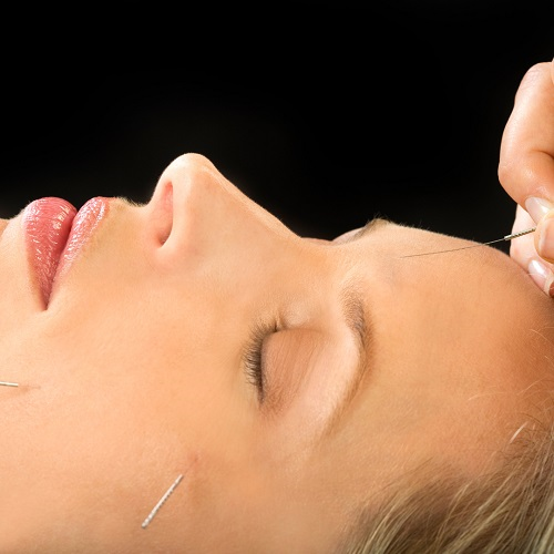 Acupuncture resized